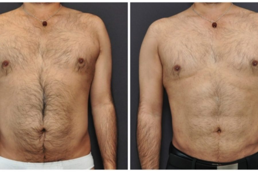 Obese people are not candidates for Liposuction